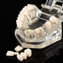 Transparente Dental Implantation Disease Zähne Modell Lehre Zähne Werkzeug Dental Adult Typodont Abnehmbare Zähne Modell