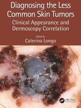 Diagnosing the Less Common Skin Tumors