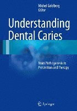 Understanding Dental Caries